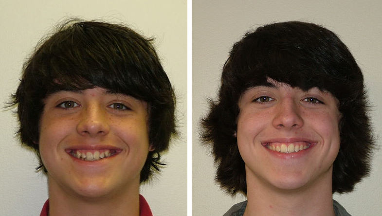 Before and after smile using the Damon System at Bruner Orthodontics in Redmond, WA