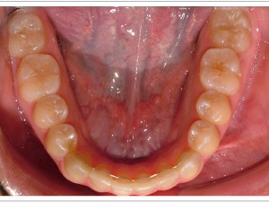 A lower bonded retainer at Bruner Orthodontics