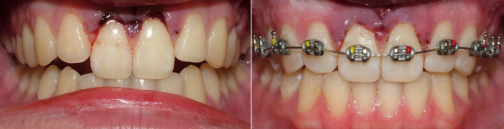 KC 3 before after IC