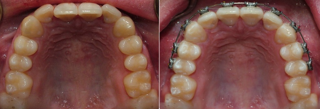 KC 3 before after OU