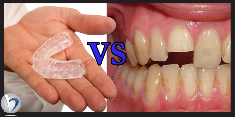 Mouthguard vs injury image